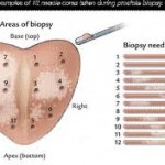 blind biopsies are painful and inaccurate
