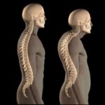 men can develop osteoporosis as young as 34